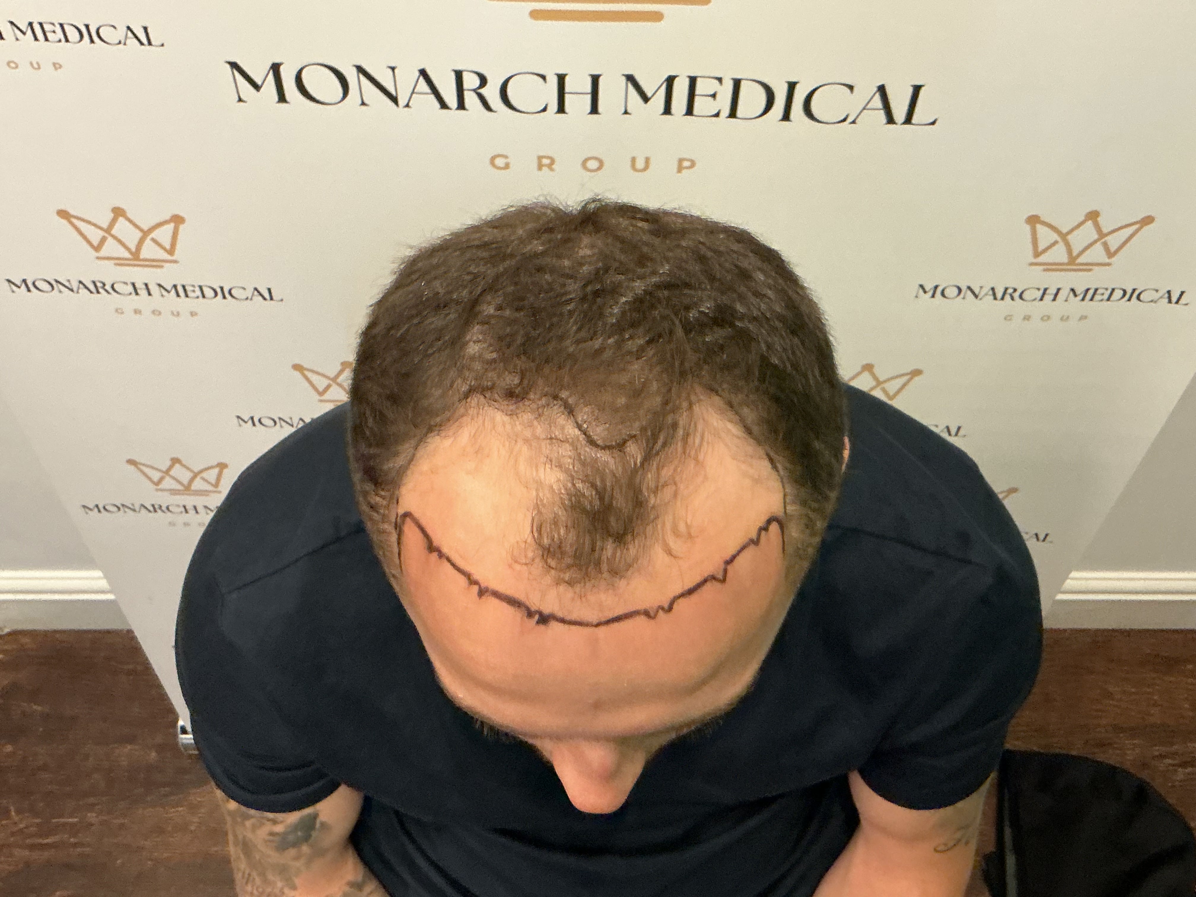 Advanced hairline recession — result photo 2